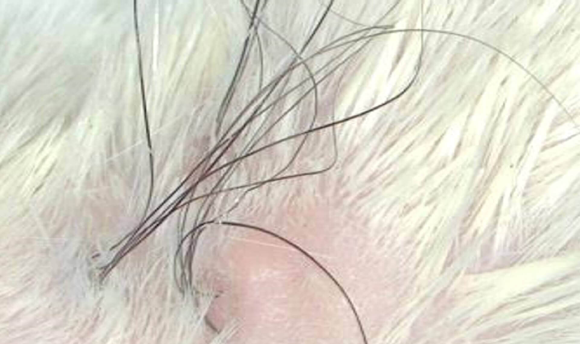 Healthy scalp skin xenotransplanted on mouse
